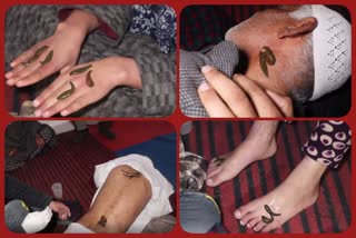 leech therapy on nowroz in kashmir