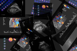 stroke, stroke time, angiography