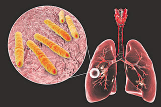 World Tuberculosis Day 2021: