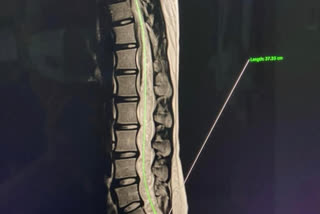 fortis hospital12 hours marathon surgery