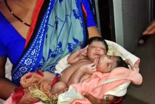 Baby born with two heads and three arms in Kendrapara