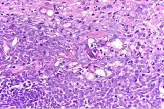 Patients with mucosal mycosis have been found in Amravati district