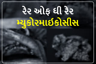 વગર લક્ષણ પ્રથમવાર મસ્તિષ્કમાં ફંગસનો કેસ