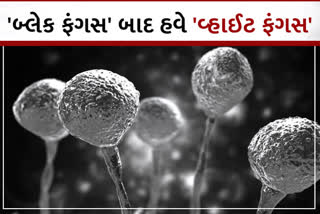 ગુજરાતમાં વ્હાઈટ ફંગસનો પગપેસારો, સોલા સિવિલ હોસ્પિટલમાં 3 દર્દીઓ સારવાર હેઠળ