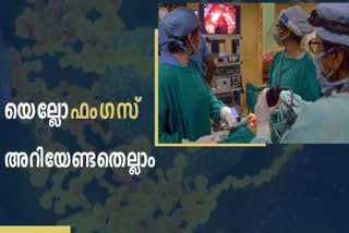 First yellow fungus case reported in Ghaziabad  yellow fungus  Symptoms of yellow fungus  prognosis of yellow fungus  യെല്ലോ ഫംഗസ്  യെല്ലോ ഫംഗസ് ലക്ഷണങ്ങൾ  യെല്ലോ ഫംഗസ് മുൻകരുതലുകൾ