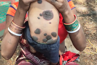 black-spots-on-the-body-of-a-two-and-a-half-month-old-girl-in-jholarao-vanagram-of-gariaband-district
