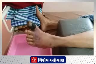 કોરોના બાદ ડ્રાય ગેંગરીનના કેસમાં વધારો