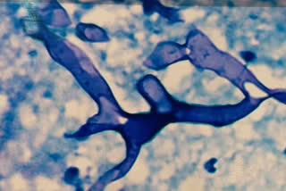 Mucormycosis