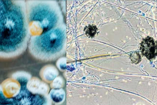 aspergillus-fungus-confirmation-in-a-patient-of-agra