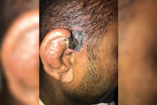 India's first case of cutaneous mucormycosis found in Karnataka