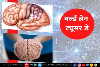 ब्रेन ट्यूमर: लक्षण, प्रकार और उपचार