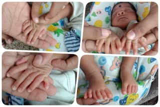 BOY BORN WITH POLYDACTYLY