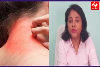 know-about-what-are-remedies-of-skin-allergies-by-experts