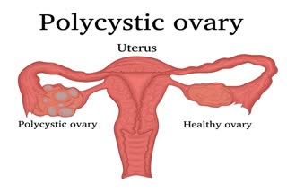 PCOS, infertility, KIMS hospital