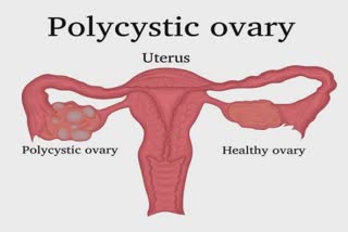 PCOS મહિલાઓને વંધ્યત્વ તરફ લઈ જઇ શકે છે