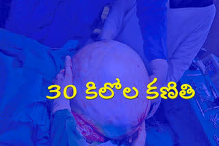 30 kg tumor in female stomach   at proddutur
