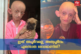 benjamin button disease  asanthi smith dies  ashanthi smith dies  അശാന്തി സ്മിത് മരിച്ചു  ബെഞ്ചമിൻ ബട്ടൺ രോഗം  അശാന്തി സ്മിത്ത് വാർത്ത