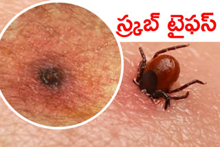 Scrub Typhus