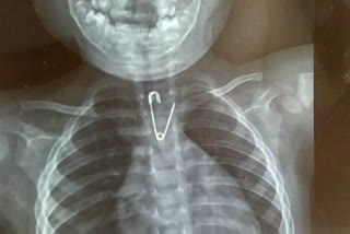 Doctors Successfully Oparet a Safety Pin from One Year Old Child Esophagus in North Bengal Medical College and Hospital