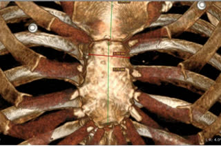 Gender can be identified with CT Scan