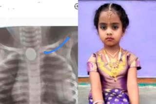 Child died after swallowing a 5 rupee coin