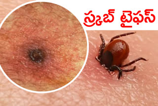 Scrub Typhus reported in five districts of MP, Government issues alert