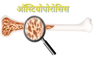 ऑस्टियोपोरोसिस.