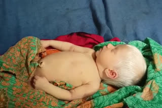 white haired baby born in JLNMCH bhagalpur