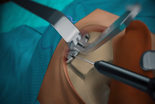 cochlear surgery at guntu ggh