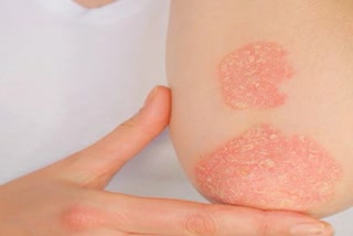 world psoriasis day 2021