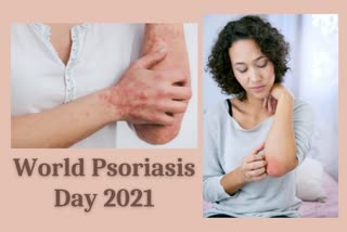 World Psoriasis Day,  Skin disorder,  Psoriasis awareness,  Psoriasis day 2021,  Skin disorder awareness,  Psoriasis treatment,  Skin disorder treatment, psoriasis day, what is psoriasis, what are the symptoms of psoriasis, what is the treatment for psoriasis, is there a treatment for psoriasis, who is at risk of having psoriasis, what can cause psoriasis flare up, what can flare up psoriasis, what can trigger psoriasis, can psoriasis be cured, skin care, skin health, dry skin, itchy skin