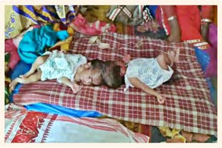 Two twins from Barpeta admitted in GMCH