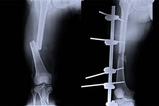 Bone Fracture