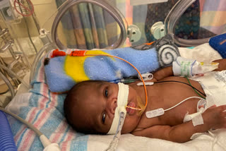 Alabama boy born in 21 weeks named world's most premature baby to survive