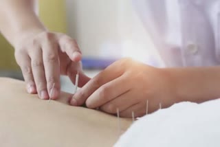 Acupuncture therapy:એક્યુપંક્ચર પદ્ધતિ વજન ઘટાડવામાં મદદરૂપ થઈ શકે