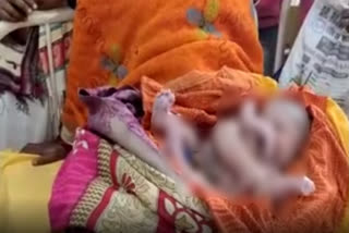 Birth of A child with four hands and legs in Katihar