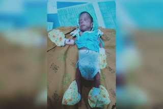 Low Birth weight Baby Rescue : માત્ર 654 ગ્રામ વજન સાથે જન્મ લેનાર બાળકને બચાવી લેવાયું