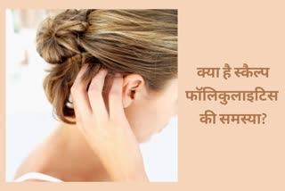 सावधानी बरत कर करें स्कैल्प फॉलिकुलाइटिस से बचाव, what is scalp folliculitis, what are the causes of scalp folliculitis, how to prevent scalp folliculitis, hair care tips