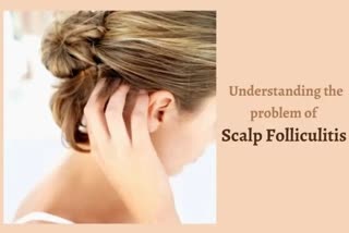 Scalp Folliculitis: ସ୍କାଲ୍‌ପ ଅଧିକ କୁଣ୍ଡାଇ ହେଉଥିଲେ ଜାଣନ୍ତୁ କାରଣ