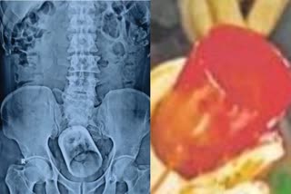 muzaffarpur patient stomach glass turned out after operation