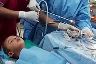 Doctors remove nail from kid throat in rare surgery