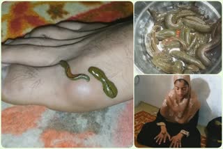 leech-therapy-marks-nawroze-in-kashmir