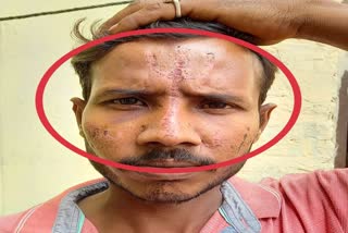 attack Dalit youth with acid in sharanpur