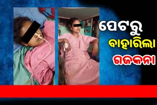 ତୃଟିପୂର୍ଣ୍ଣ ଅସ୍ତ୍ରୋପଚାର, ପ୍ରସୁତୀଙ୍କ ପେଟରେ ଛାଡ଼ିଦେଲେ ଏକ ମିଟର ଗଜକନା