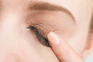 Ocular Pruritis