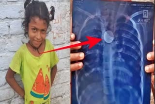 Coin stuck in girls chest in Bettiah