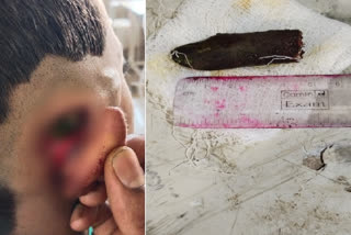 Tea tree branch taken off from boy's ear after successful operation in Jalpaiguri