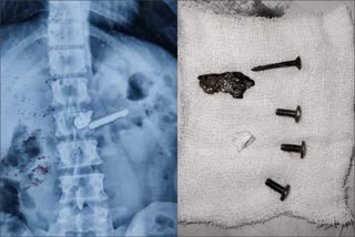 Nail Screws And Blade in Boy Stomach In Rohtak