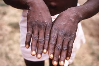 मंकीपॉक्स वायरस की पुष्टि , Monkeypox infected countries