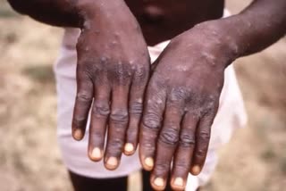 First case of Monkeypox detected in Australia and France, alert issued in Peru